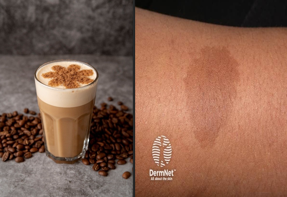 https://dermnetnz.org/imagedetail/7621-cafe-au-lait-macule
